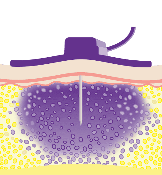 Recombinant makes room for a larger volume of IG in the body.