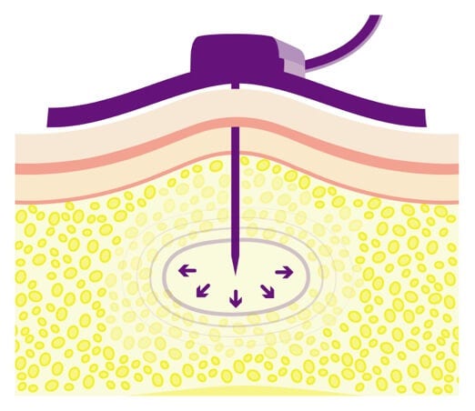 The body&#39;s natural composition of hyaluronan.
