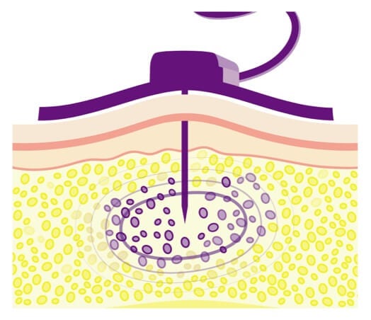 Hyaluronan in the body limiting the volume of IG that can be infused.