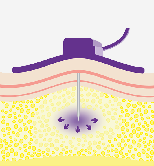 The body's natural composition of hyaluronan.