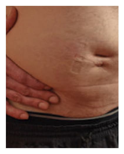 Abdomen after HyQvia infusion.