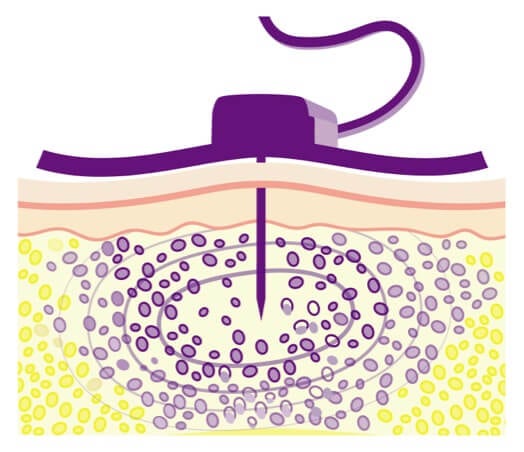 Recombinant Human Hyaluronidase makes room for a larger volume of IG in the body.