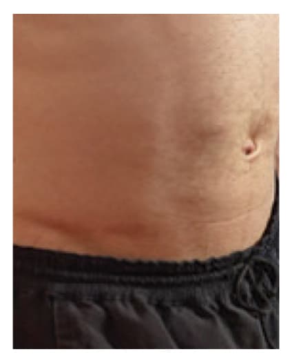 Abdomen before HyQvia infusion.