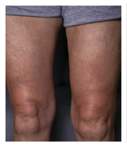 Thigh after HyQvia infusion.
