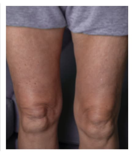 Thigh before HyQvia infusion.