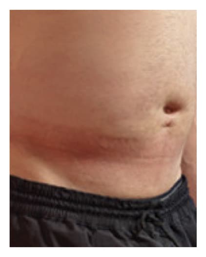 Abdomen 24 hours after HyQvia infusion.