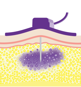 Hyaluronan in the body limiting the volume of IG that can be infused.